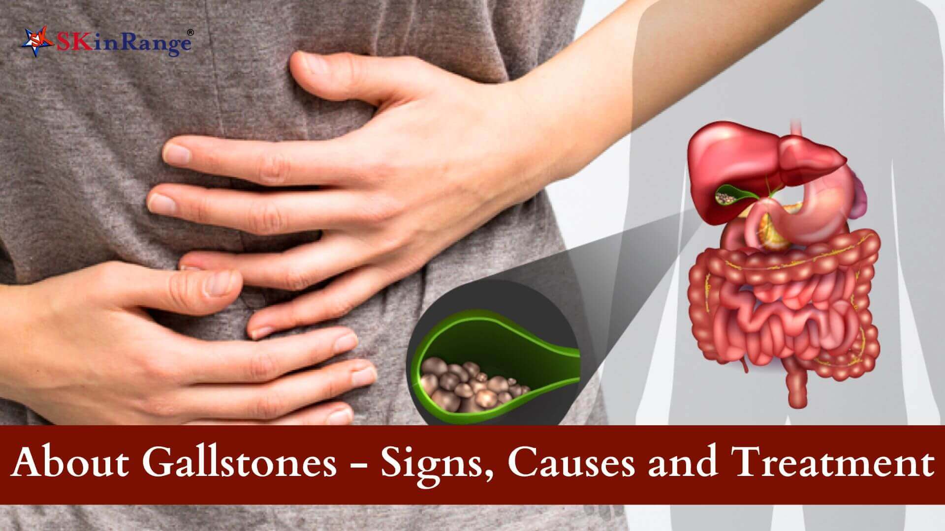 gallstones in women