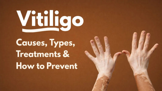 Vitiligo: Causes, Types, Treatments & Prevention Guide