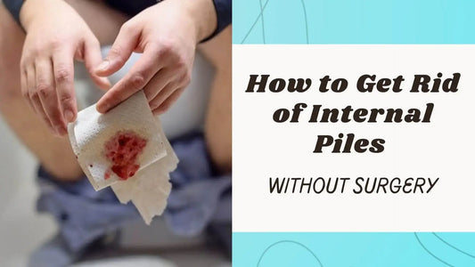 How to Get Rid of Internal Piles without Surgery